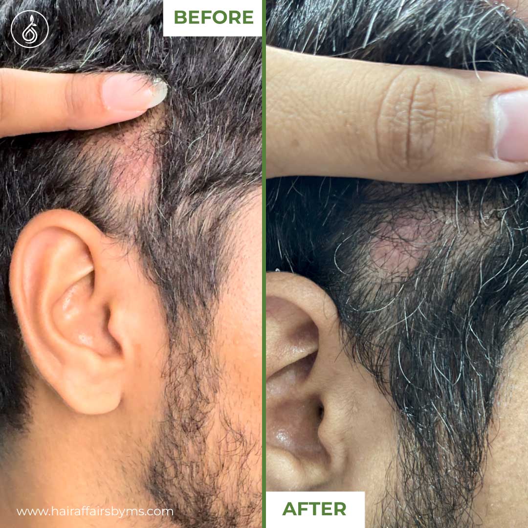 Derma roller